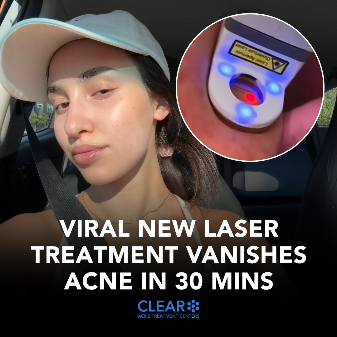 CLEAR Acne Treatment Centers Facebook ad from Jul 19, 2025