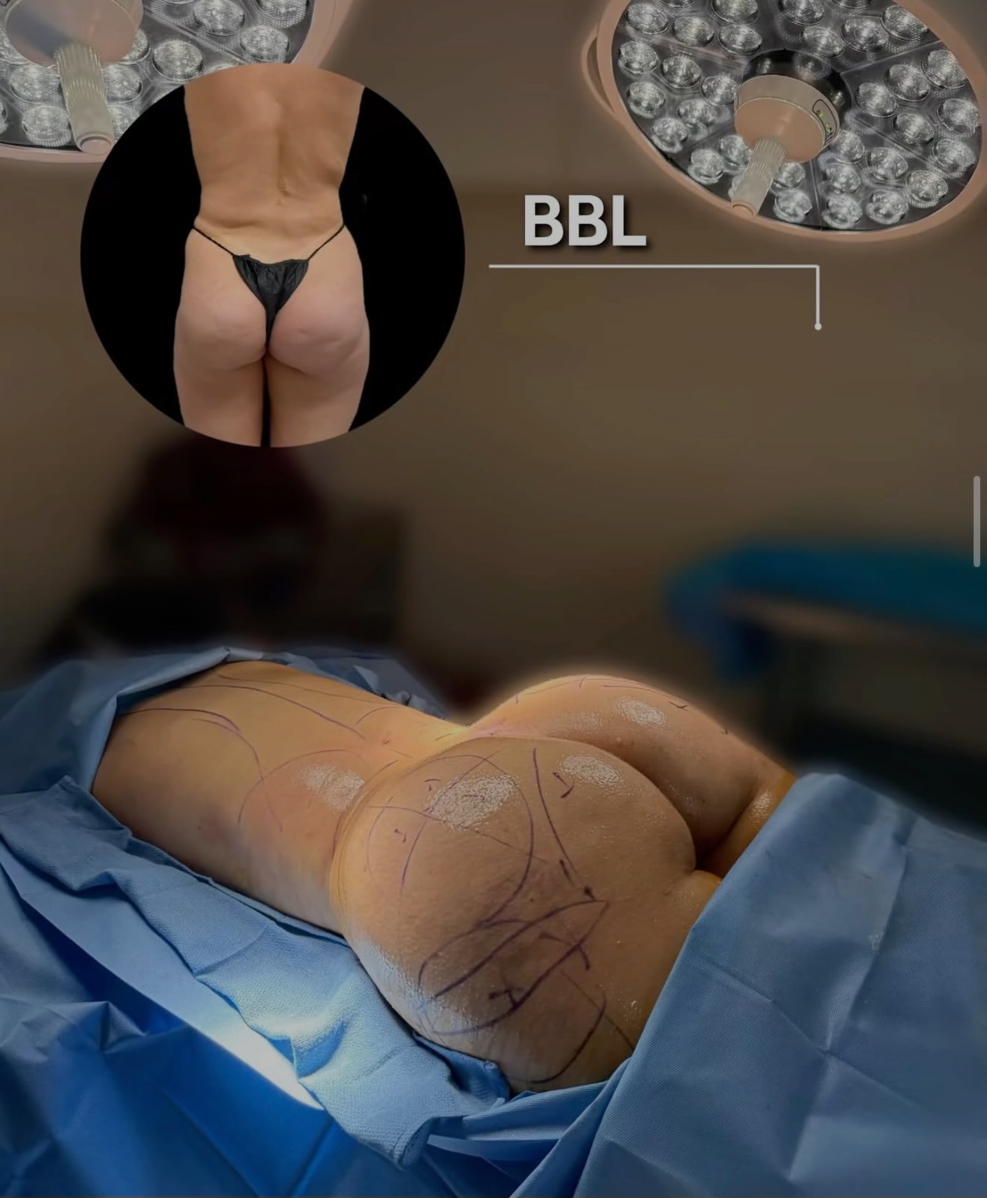 Sara's Plastic Surgery Facebook ad: BBL Consultation