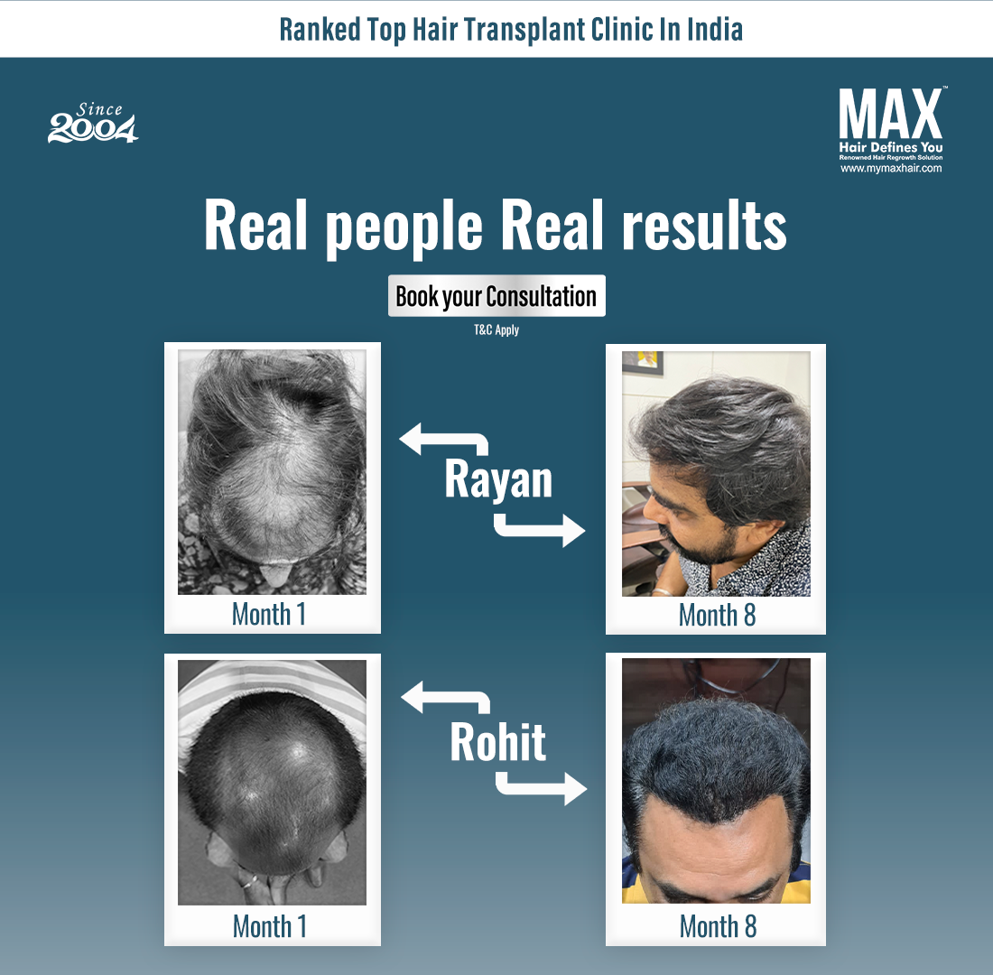MAX Hair Clinic Facebook ad