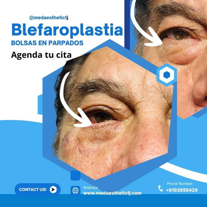 Med Aesthetic Juventud y Belleza Facebook ad: Parpados cansados?