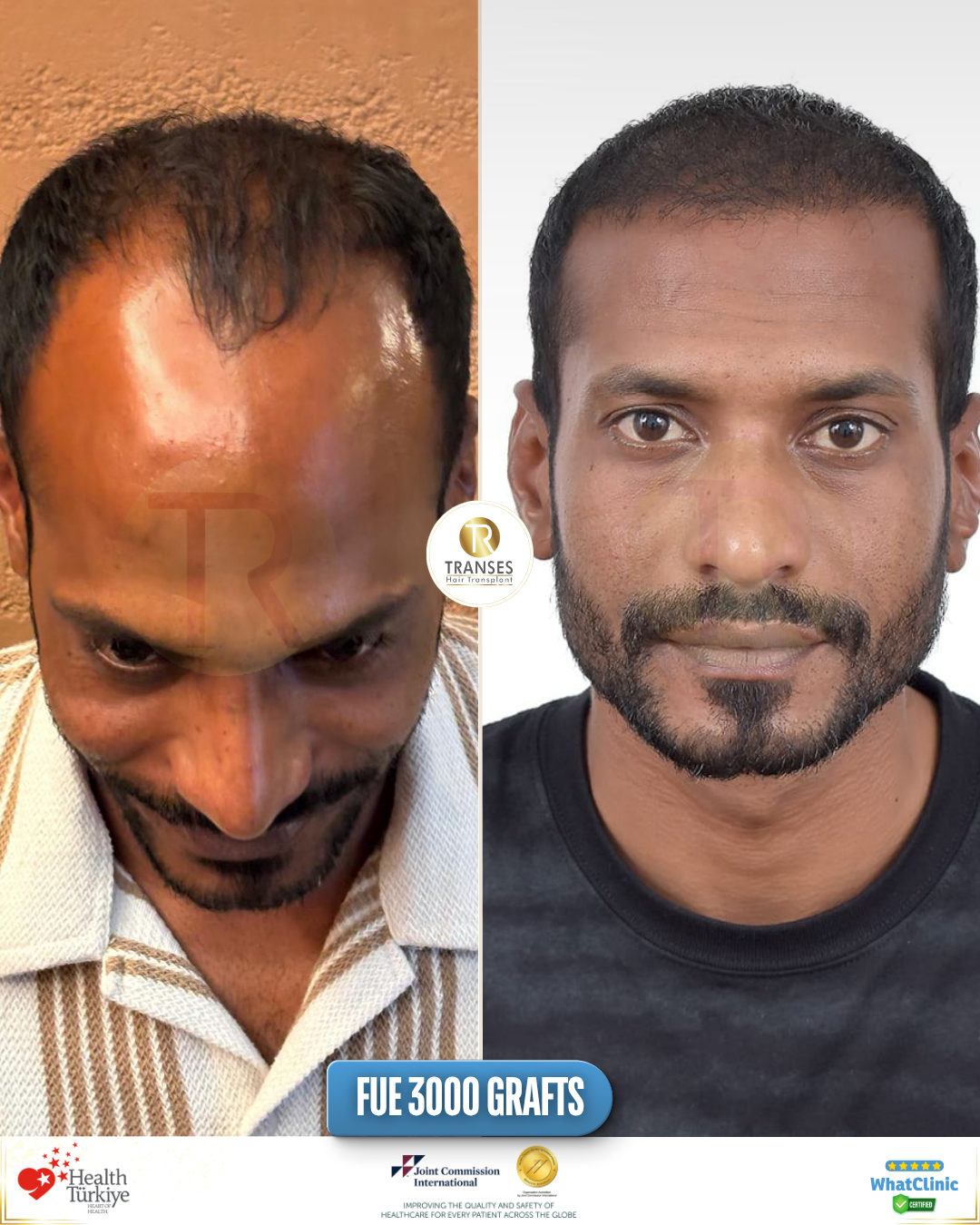 Transes Hair Transplant Facebook ad from May 22, 2026