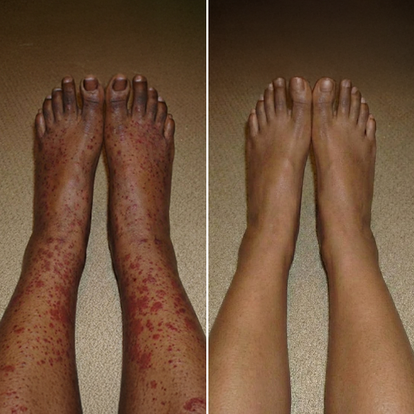 Dialyse-Selbsthilfegruppe Facebook ad