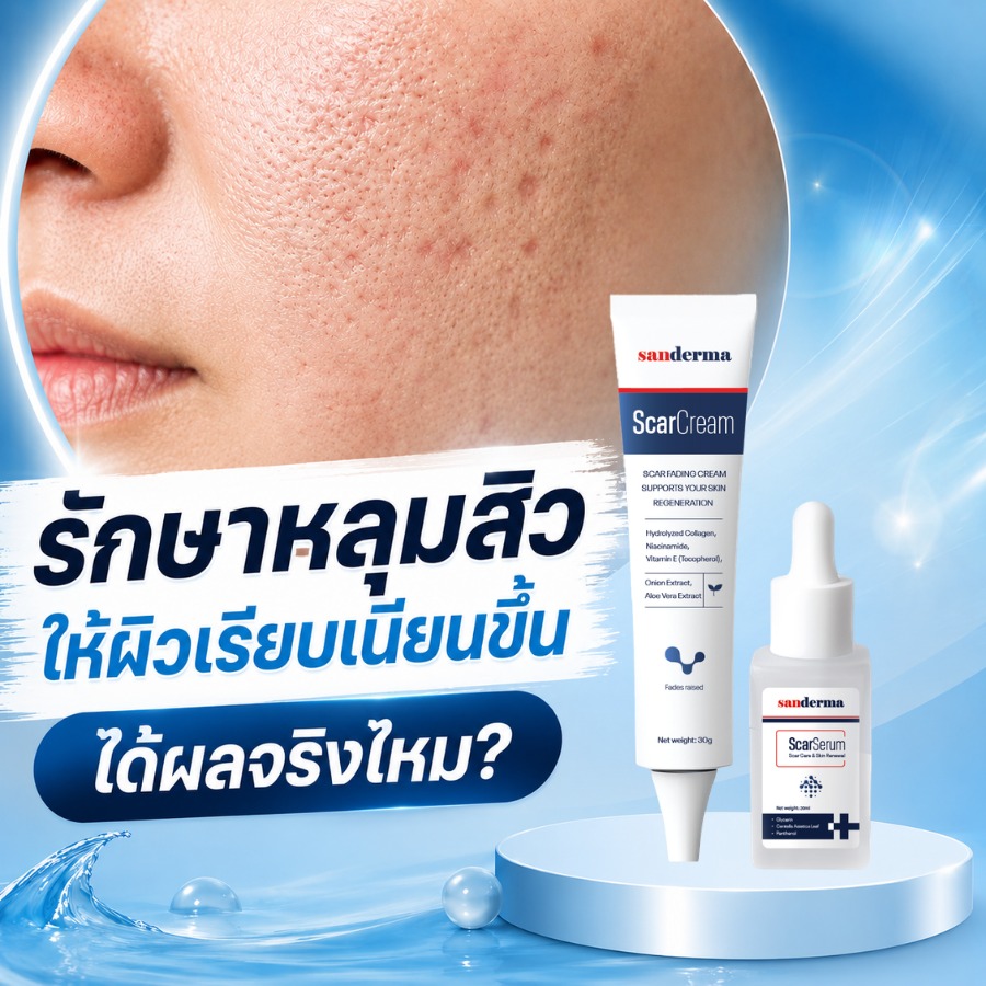 Sanderma Scar - ช่วยให้รอยแผลเป็นจางลง Facebook ad: SANDERMA, การดูแลหลุมสิวแบบ 2 ชั้น ที่หลายคนมองข้าม