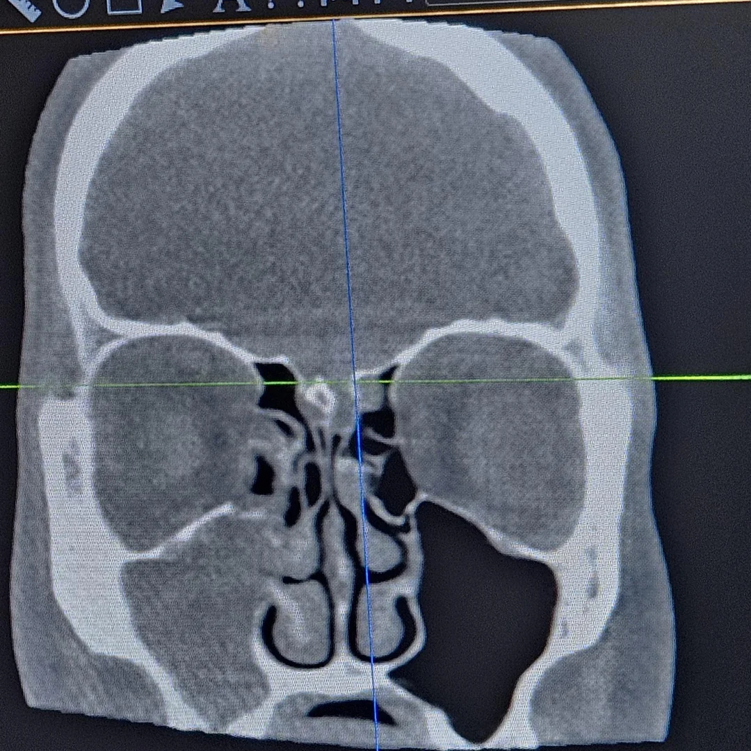 Emily Hartwell Facebook ad: Sinusitis? Read This