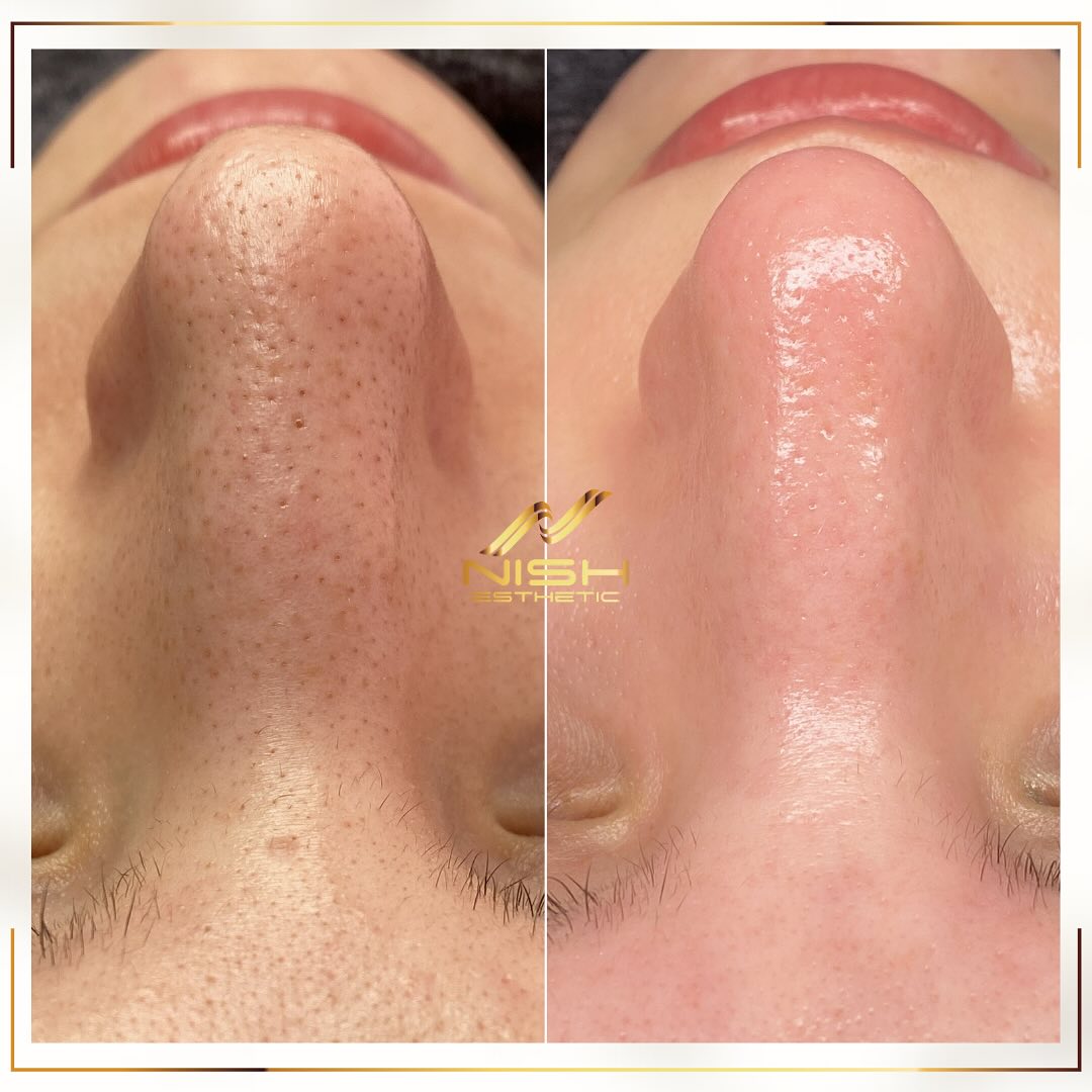 Nish Esthetic by Sibel Düz Facebook ad: Porselen Bakım & Karbon Peeling ile gerçek arındırma…