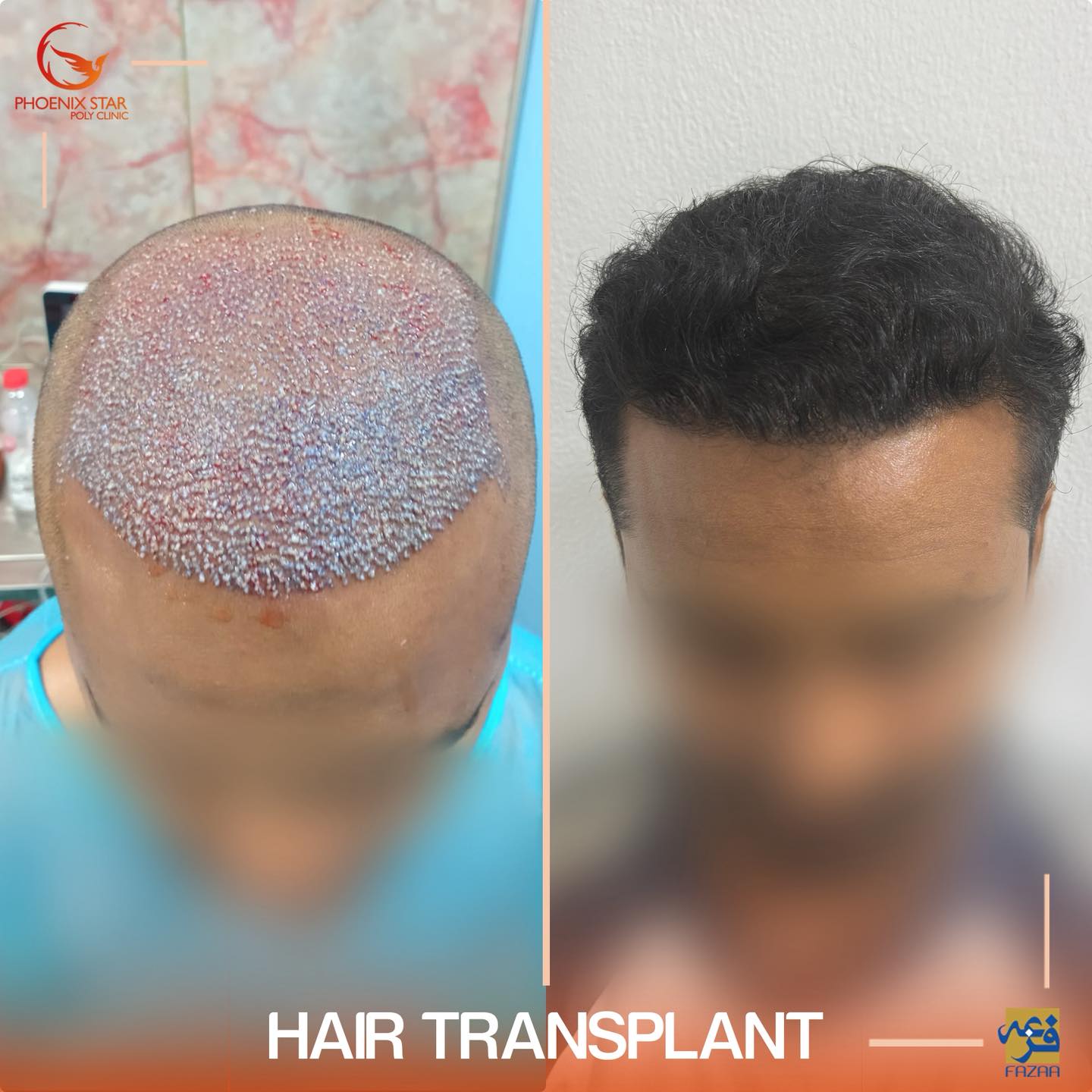 Phoenix Star Polyclinic Facebook ad: State-of-the-art hair transplant technology at Phoenix…