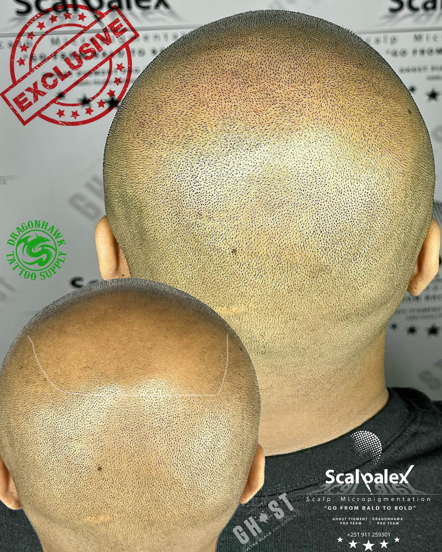 Scalpalex Scalp Micropigmentation Facebook ad: የረቀቀ የፀጉር ታቱ(Scalp Micropigmentation)