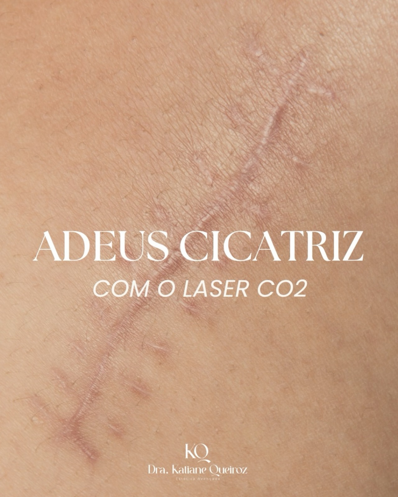 Dra. Katiane Queiroz Facebook ad: Adeus, cicatrizes. Olá, nova pele!