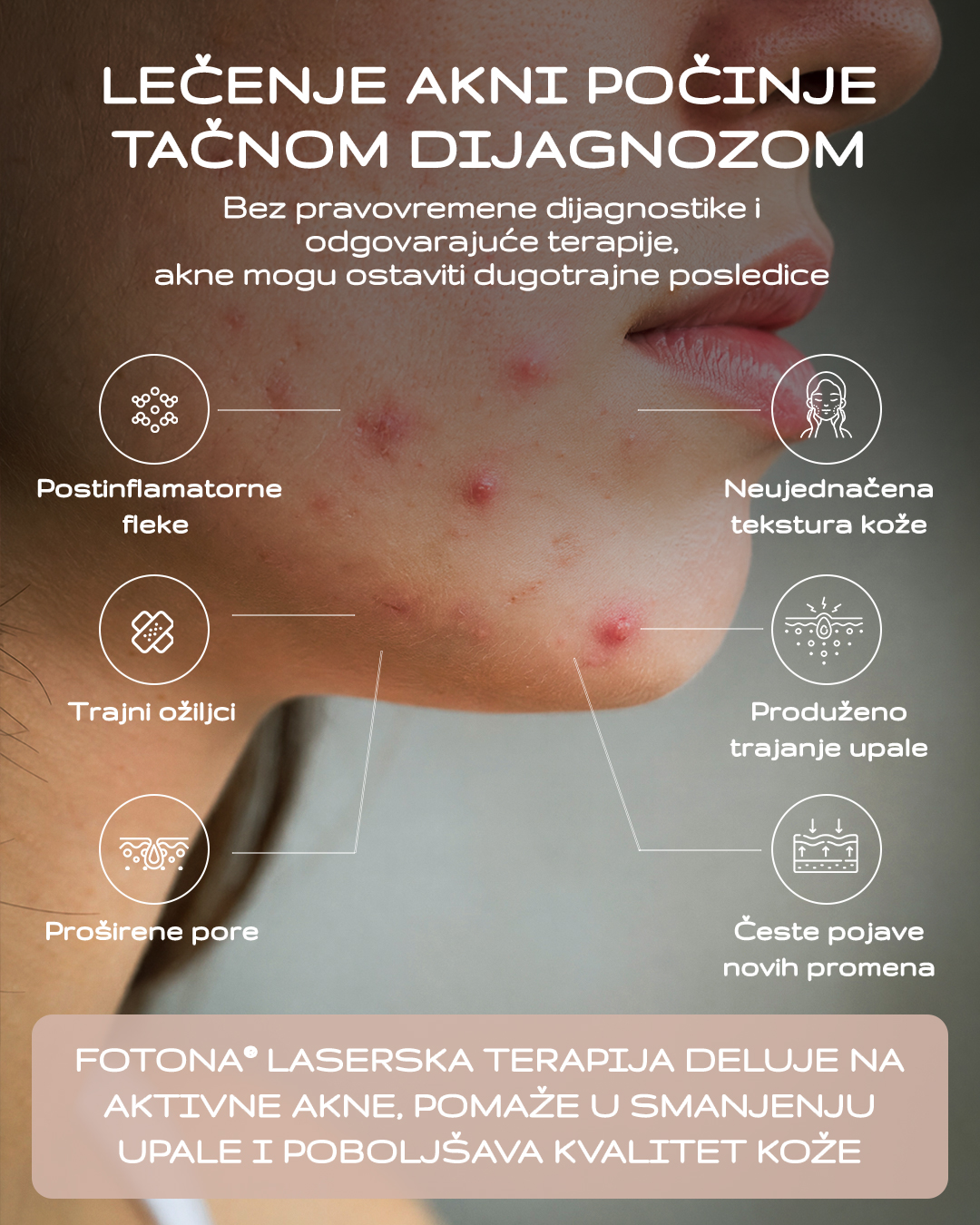 Belliva Facebook ad: Pravilno lečenje akni počinje tačnom dijagnozom!