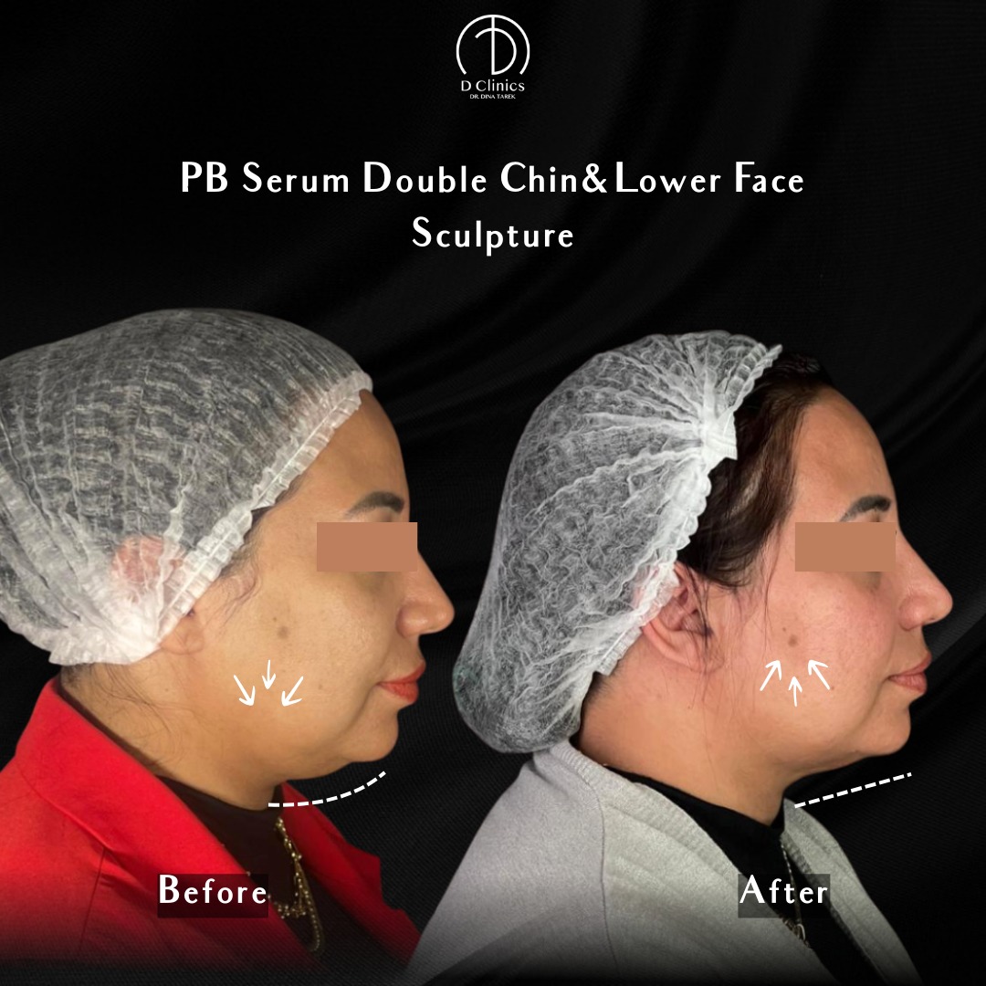Dclinics.eg Facebook ad: PB Serum Double Chin & Lower Face Sculpture