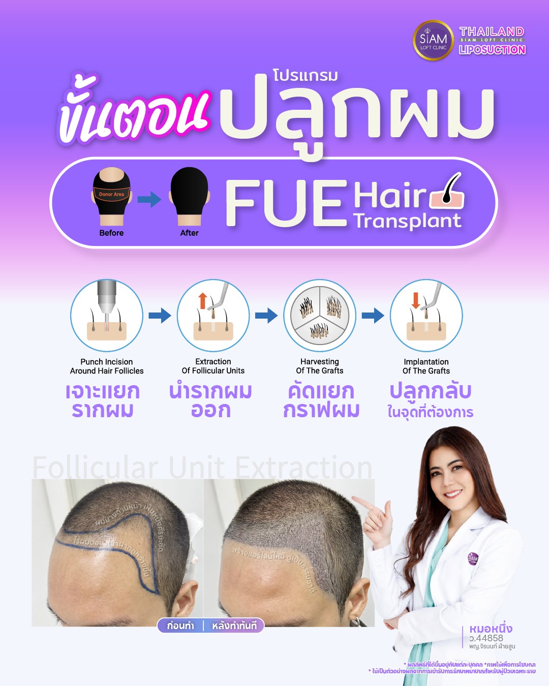 Siamloft Clinic Liposuction Thailand by Dr.Nueng Facebook ad