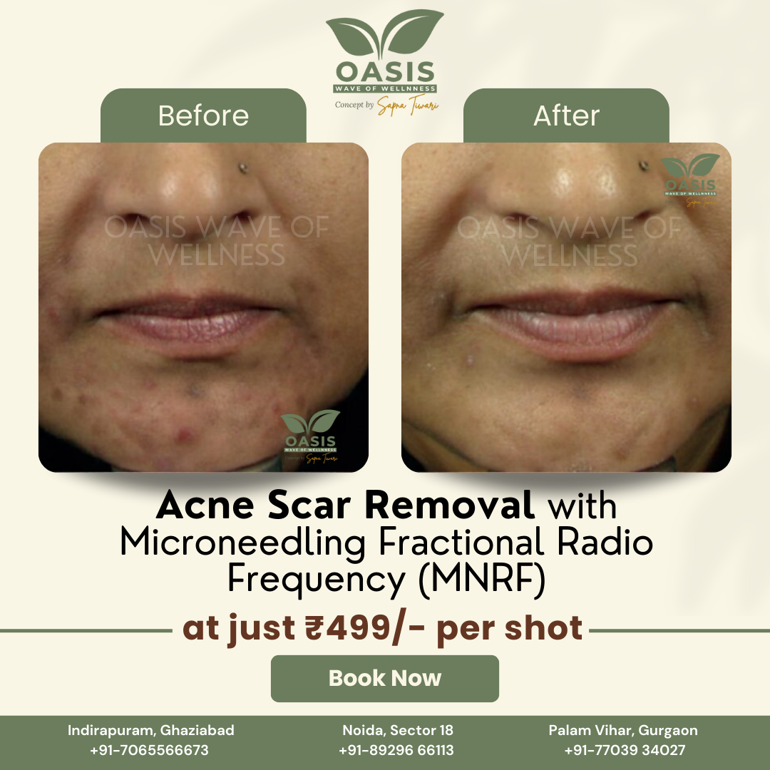 Oasis - Wave of Wellnness Facebook ad: Struggling with acne scars, stretch marks, wrinkles, or…