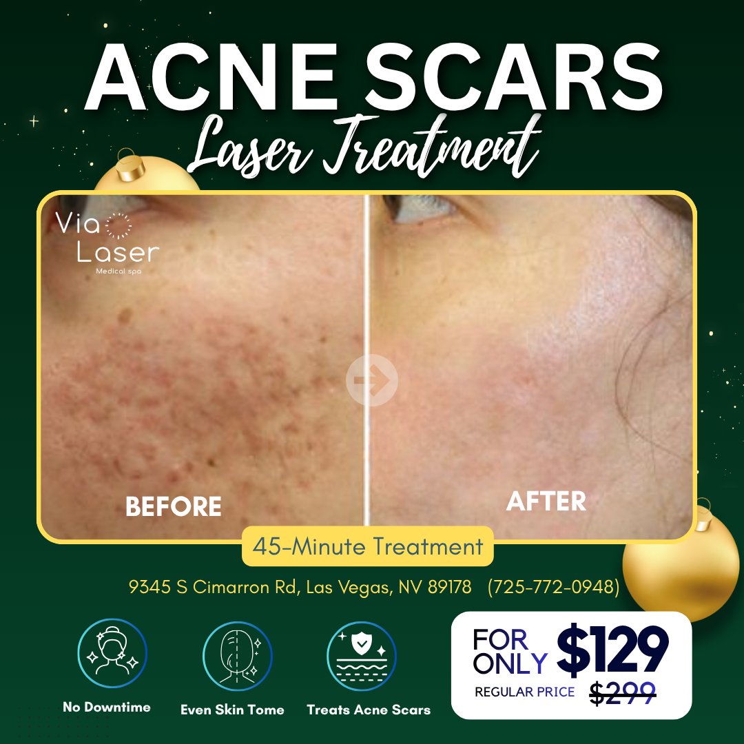 Via Laser Facebook ad: Book Now
