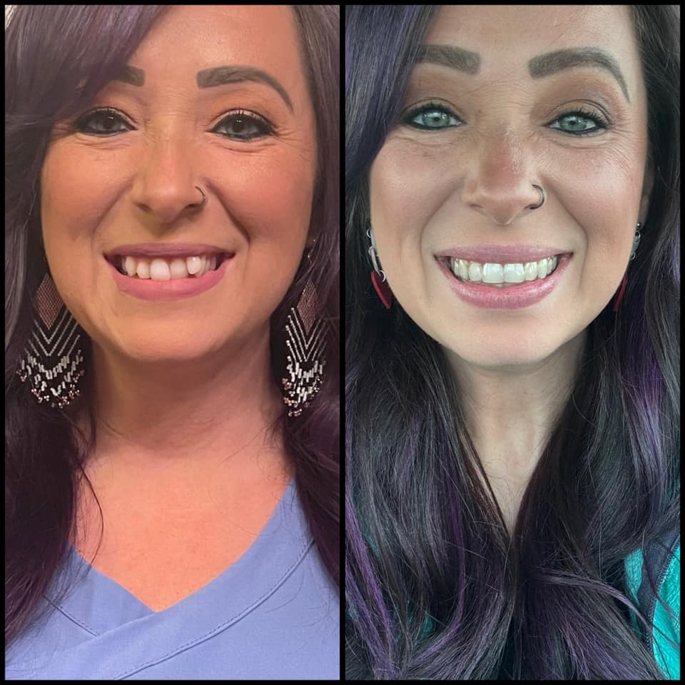 Invisalign Facebook ad