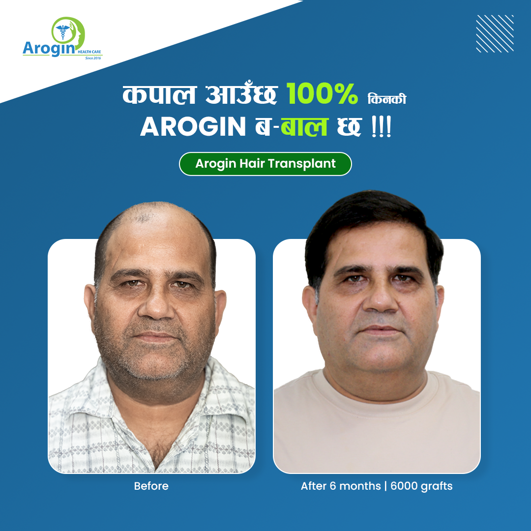 Arogin Healthcare - Hair Transplant Center Nepal Facebook ad