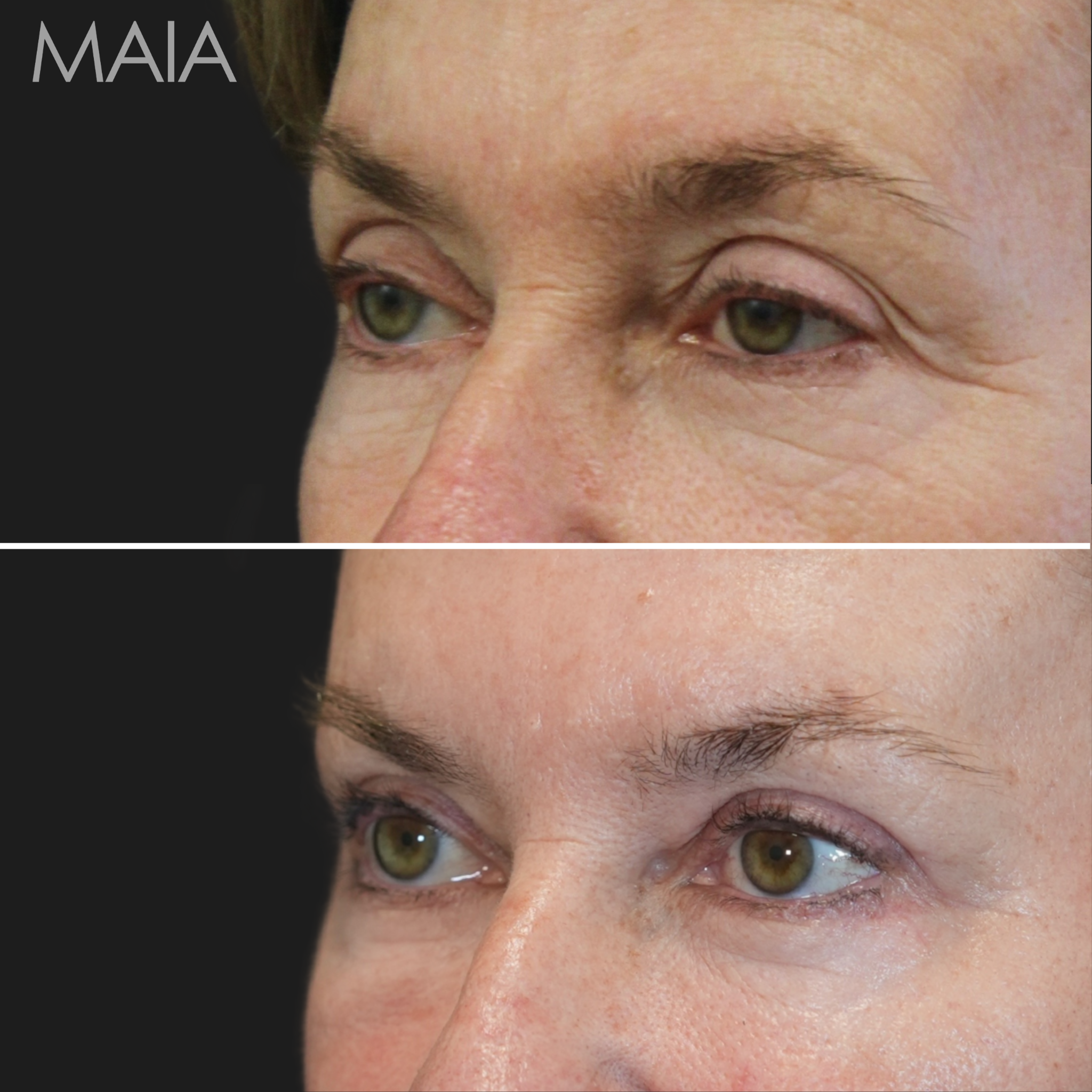 Maia Plastic Surgery: Dr. Munique Maia Facebook ad: Our 64-year-old patient is a vibrant woman whose…