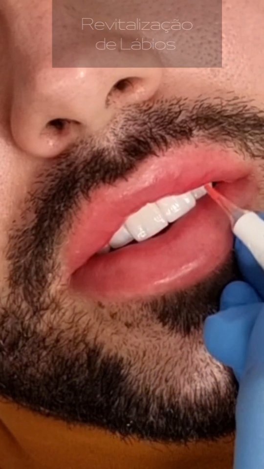 Philipe Oliveira Facebook ad: Revitalização de Lábios Masculino