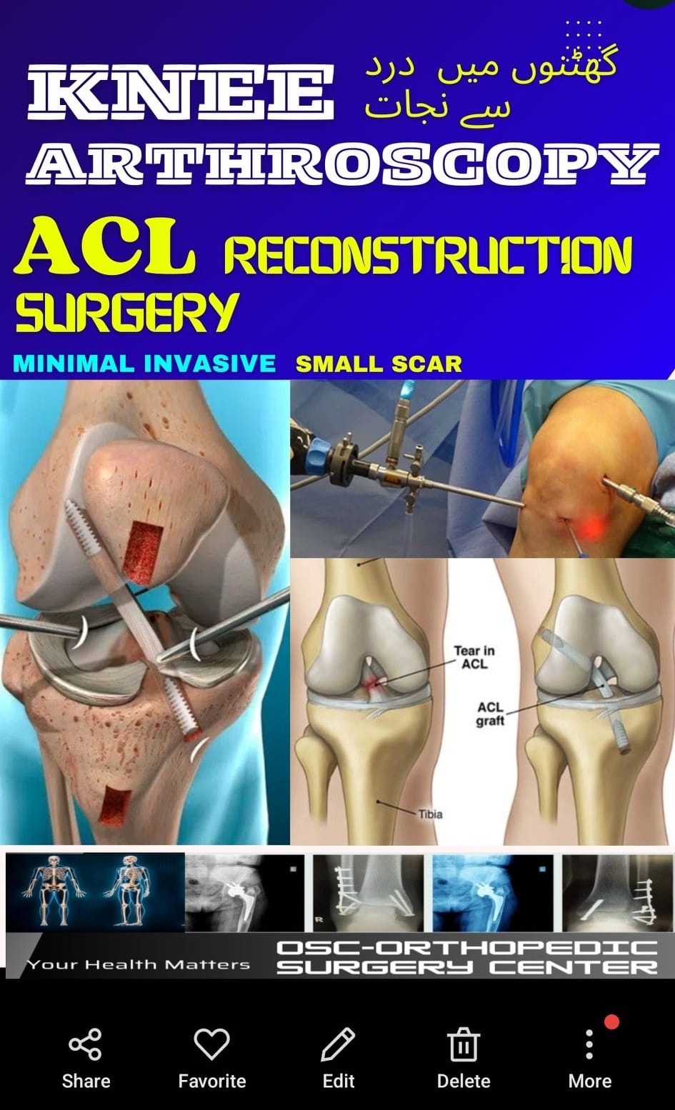 OSC-Orthopedic Surgery Center Facebook ad: ACL Surgery on SEHAT CARD