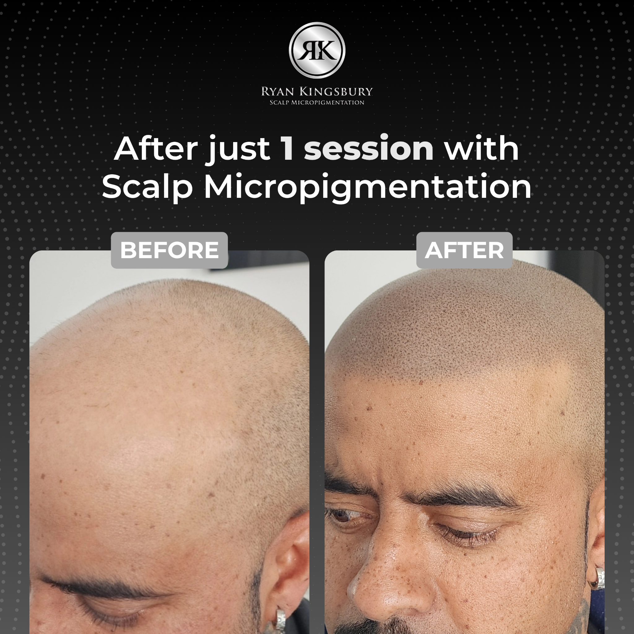 RK Scalp Micropigmentation Facebook ad