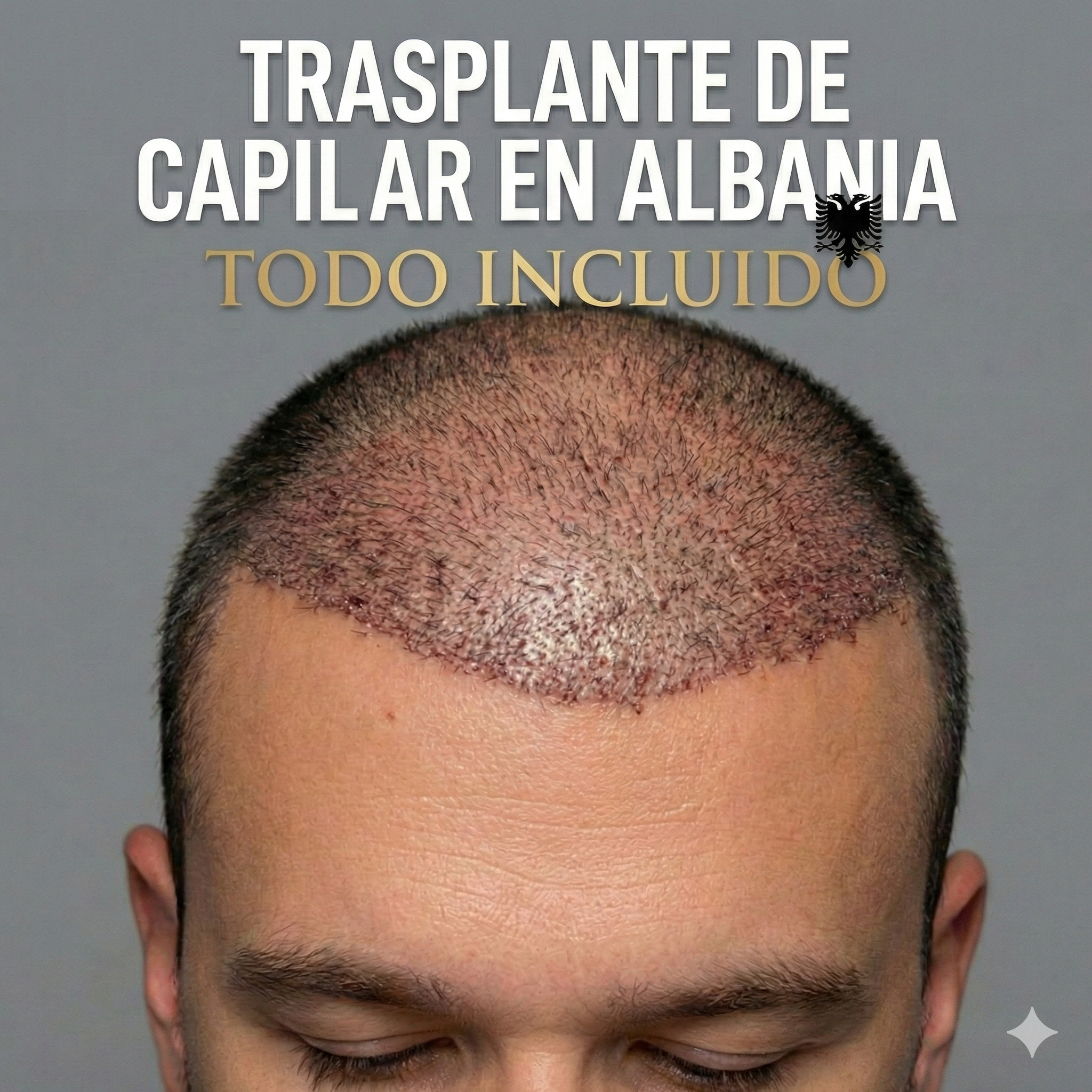 Hair Transplant by ADA Facebook ad: Recupera tu Pelo Hoy