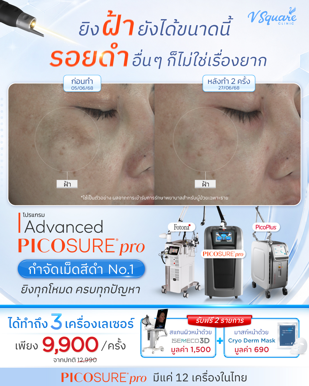 V Square Pico laser ฝ้า กระ หลุมสิว หน้าใส Facebook ad