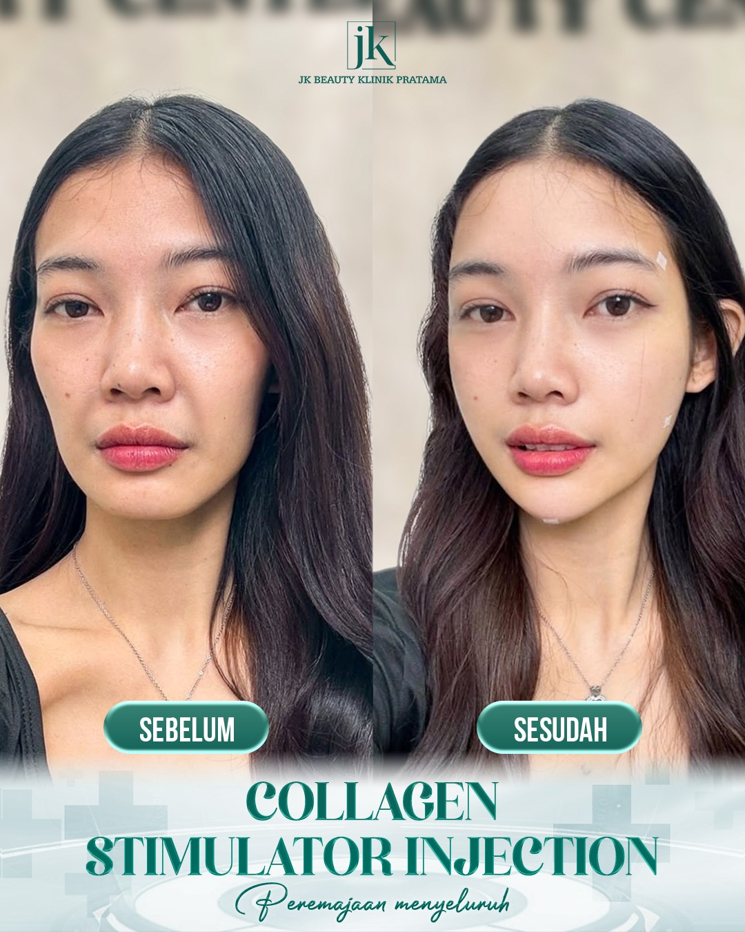 Collagen Stimulator Injection - JK Beauty Klinik Pratama Facebook ad: Sepanjang tahun bekerja hanya menunggu akhir tahun untuk…