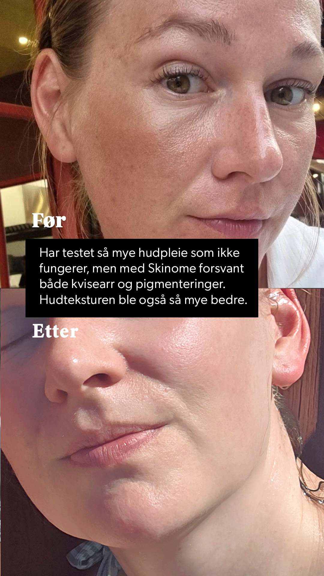 Skinome Facebook ad: Prøvd alt? Oppdag Skinome Azeretinal