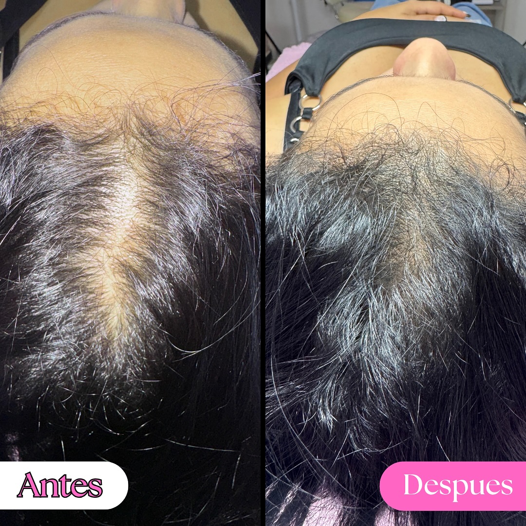 Valentina Alvarez Facebook ad: Antes y Después con Mesoterapia Capilar