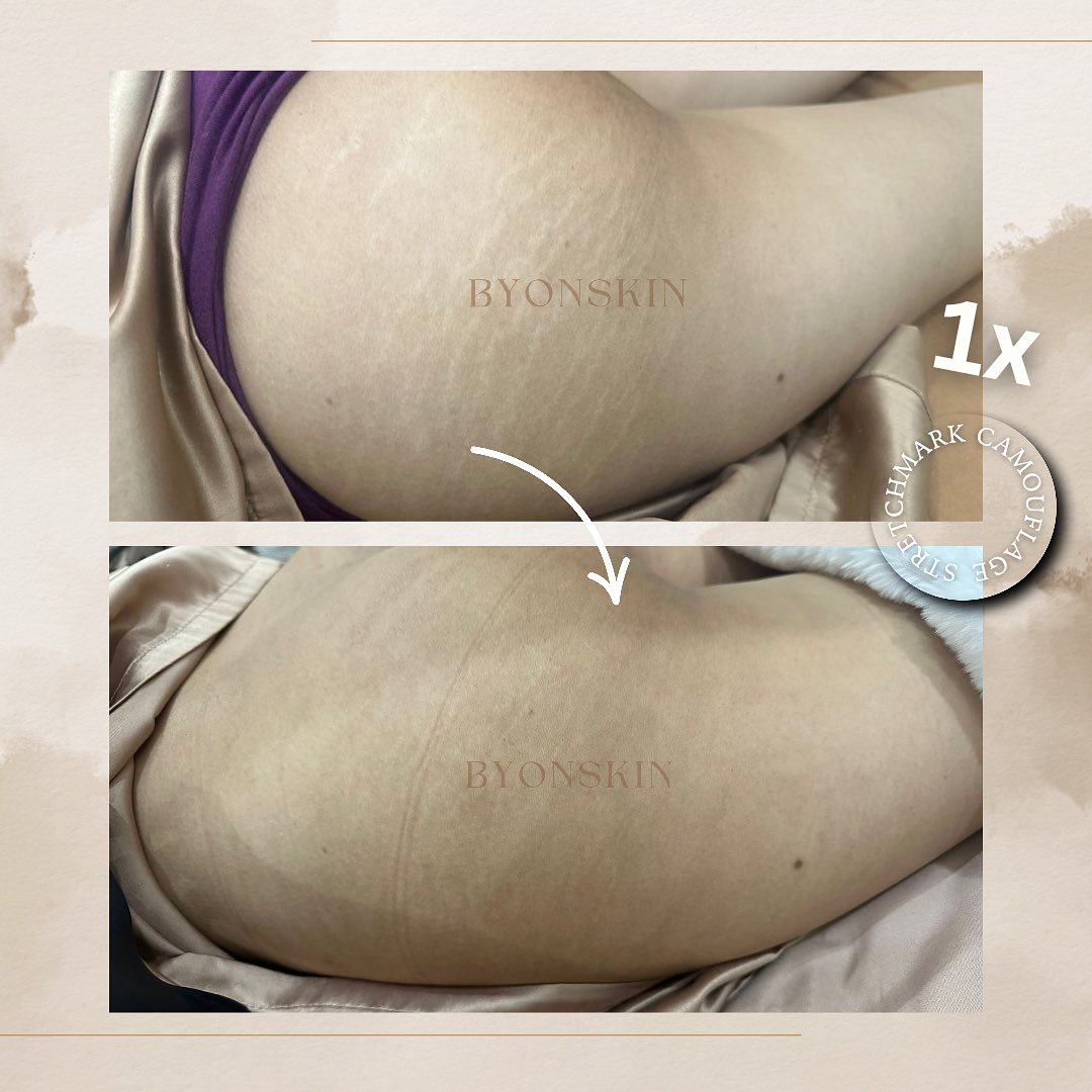 Byonskinpik Facebook ad