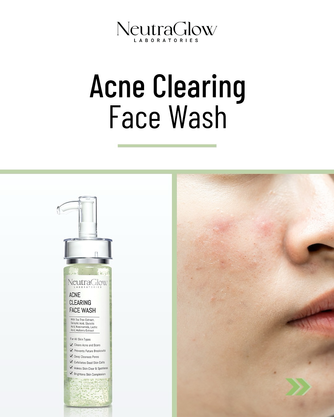 NeutraGlow Facebook ad: Get rid of acne & enjoy clear, glowing…
