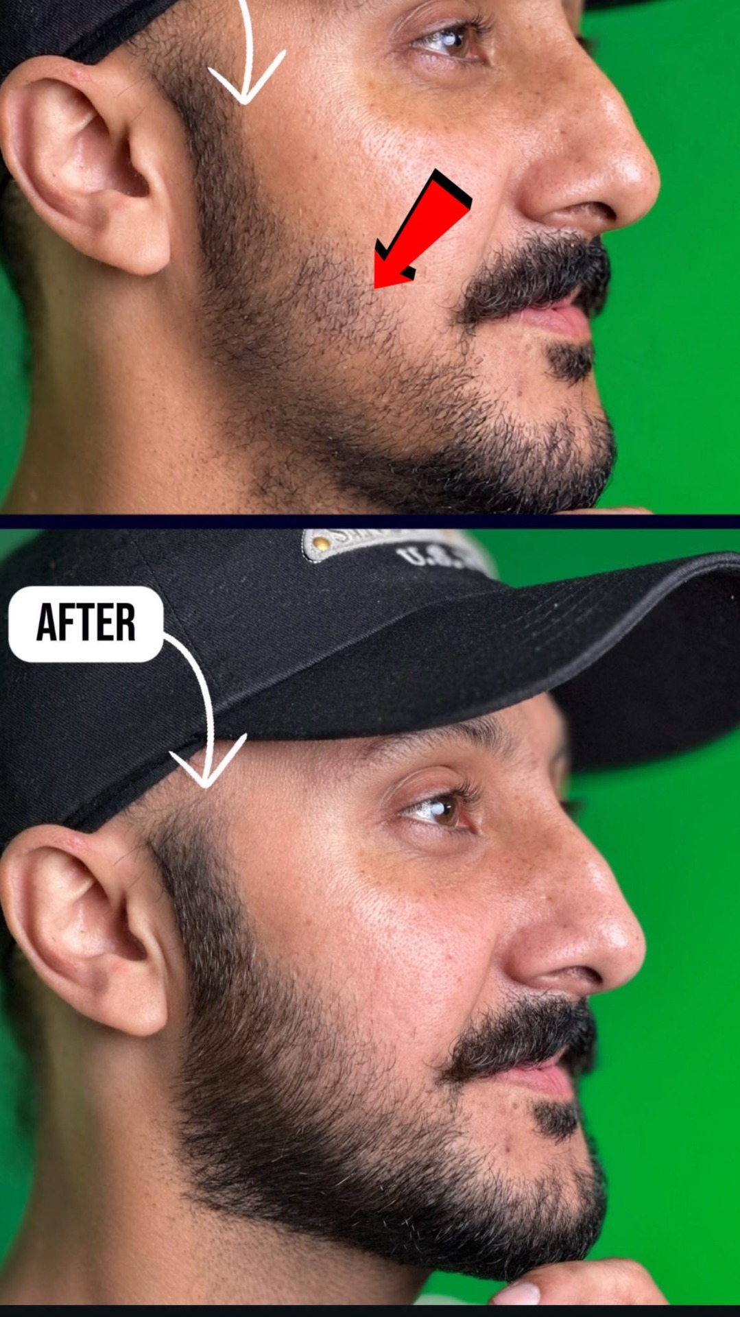 Bare Anatomy Facebook ad: Agar Tumhari beard bhi patchy hai aur Tum…