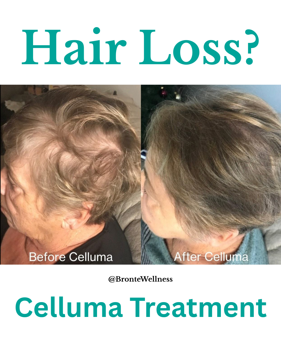 Bronte Wellness Boutique Facebook ad: Celluma Therapy + Acupuncture for Hair Loss