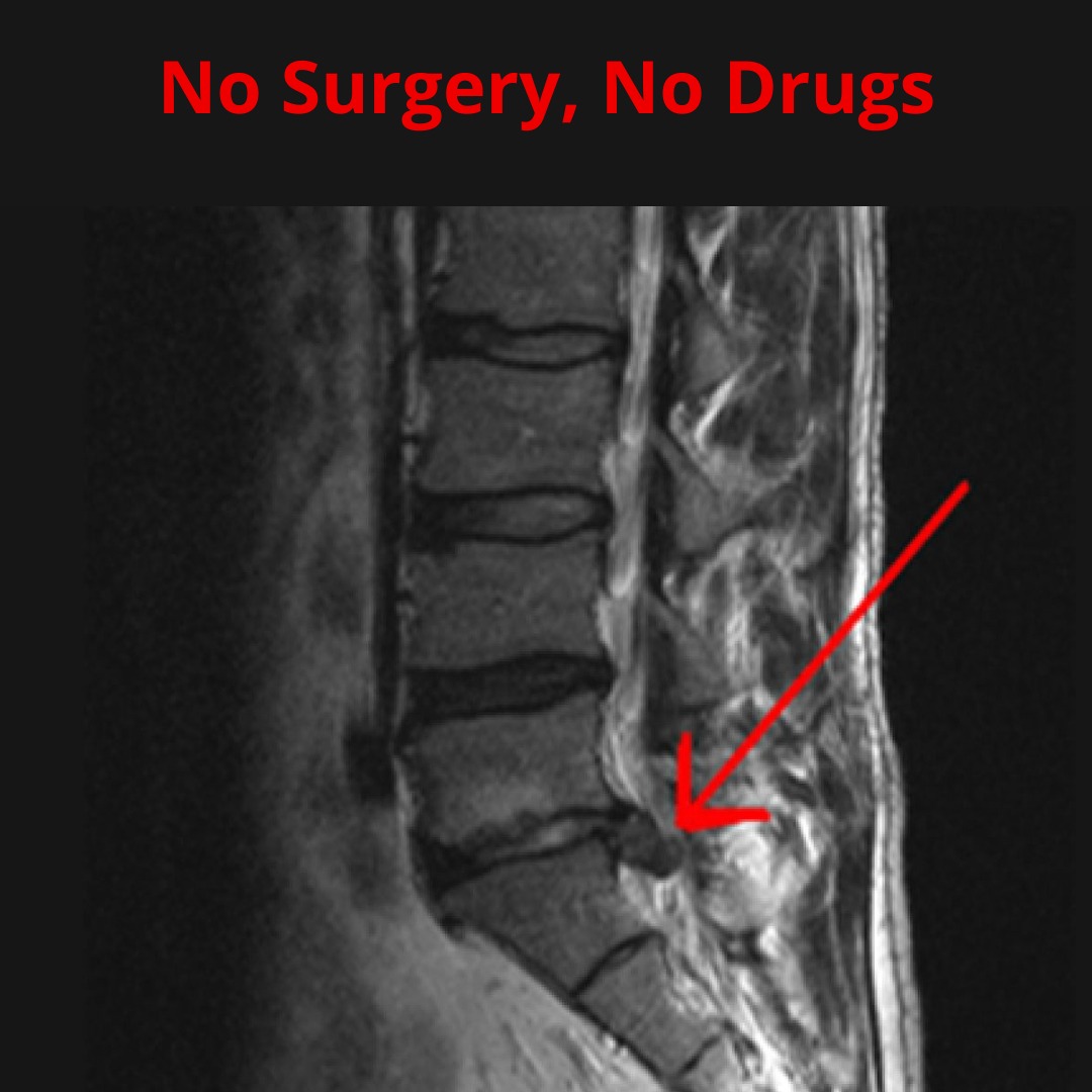 Tarpon Spine Center Facebook ad: Free Spinal Decompression Consultation + Exam