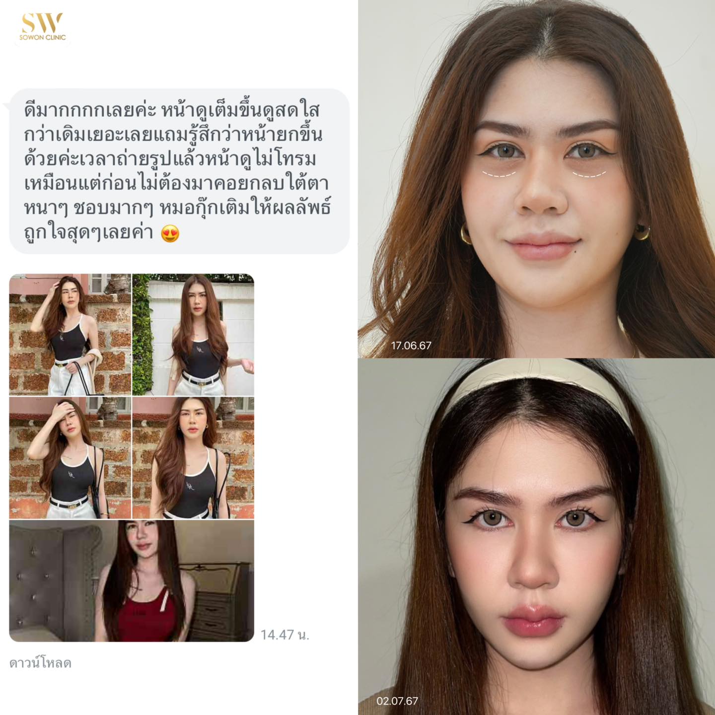 Sowon clinic Botox Filler HIFU ร้อยไหม โบท็อกซ์ ฟิลเลอร์ ปรับรูปหน้า Facebook ad