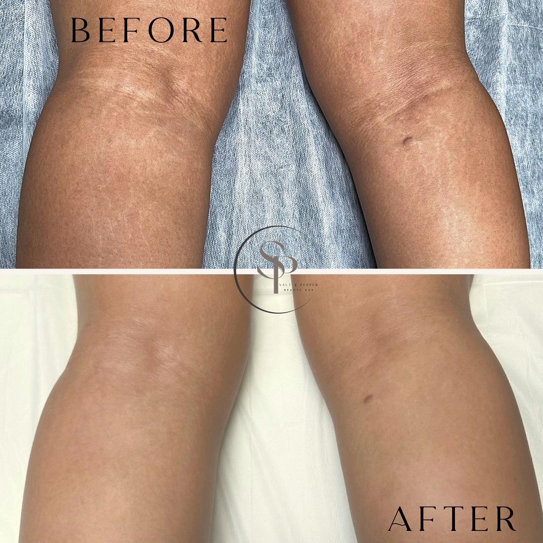 Salt & Pepper Beauty Bar Facebook ad: � Bye-bye, white stretch marks!