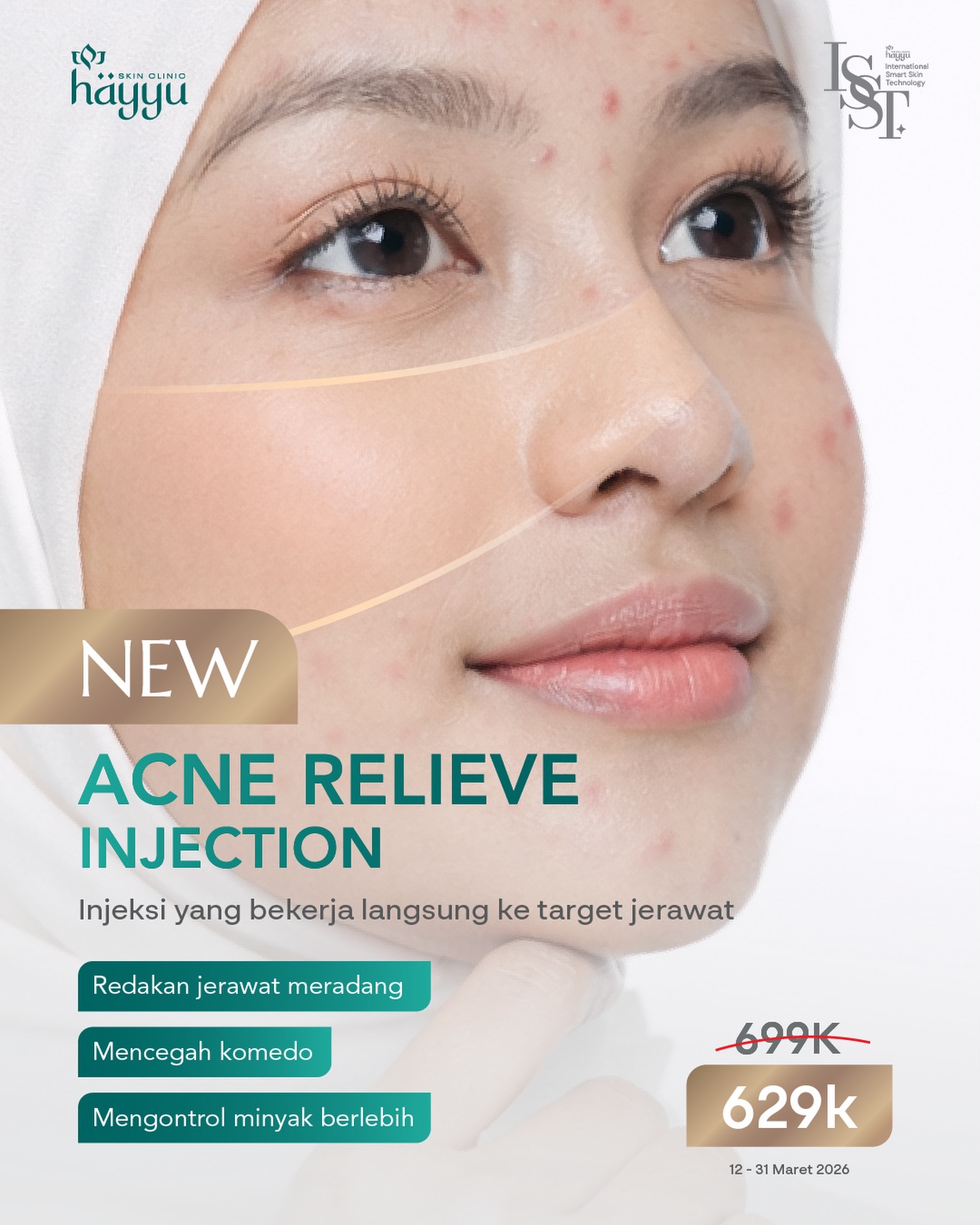 Hayyu Clinic Facebook ad: NEW INNOVATION ACNE TREATMENT