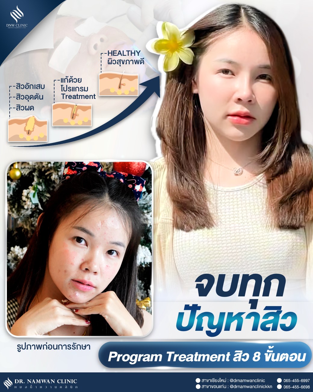 Dr.Namwan Clinic หมอน้ำหวานคลินิก คลินิกเวชกรรม ขอนแก่น Facebook ad: บอกลาสิว! เปลี่ยนหน้าสิวให้เป็นหน้าสวยใส �