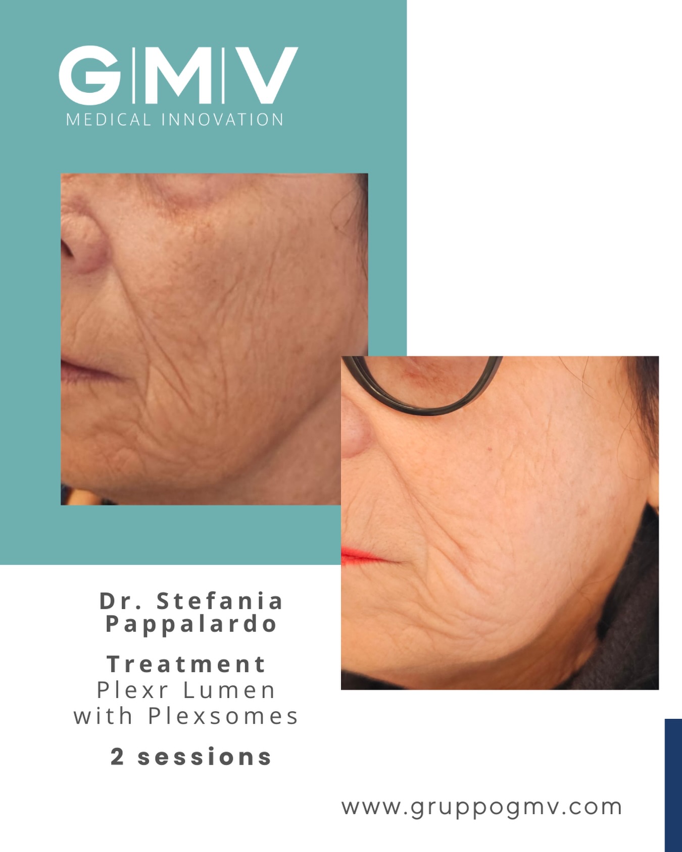 GMV Medical Innovation Facebook ad: Plexr Lumen - The new frontier of combined skin regeneration