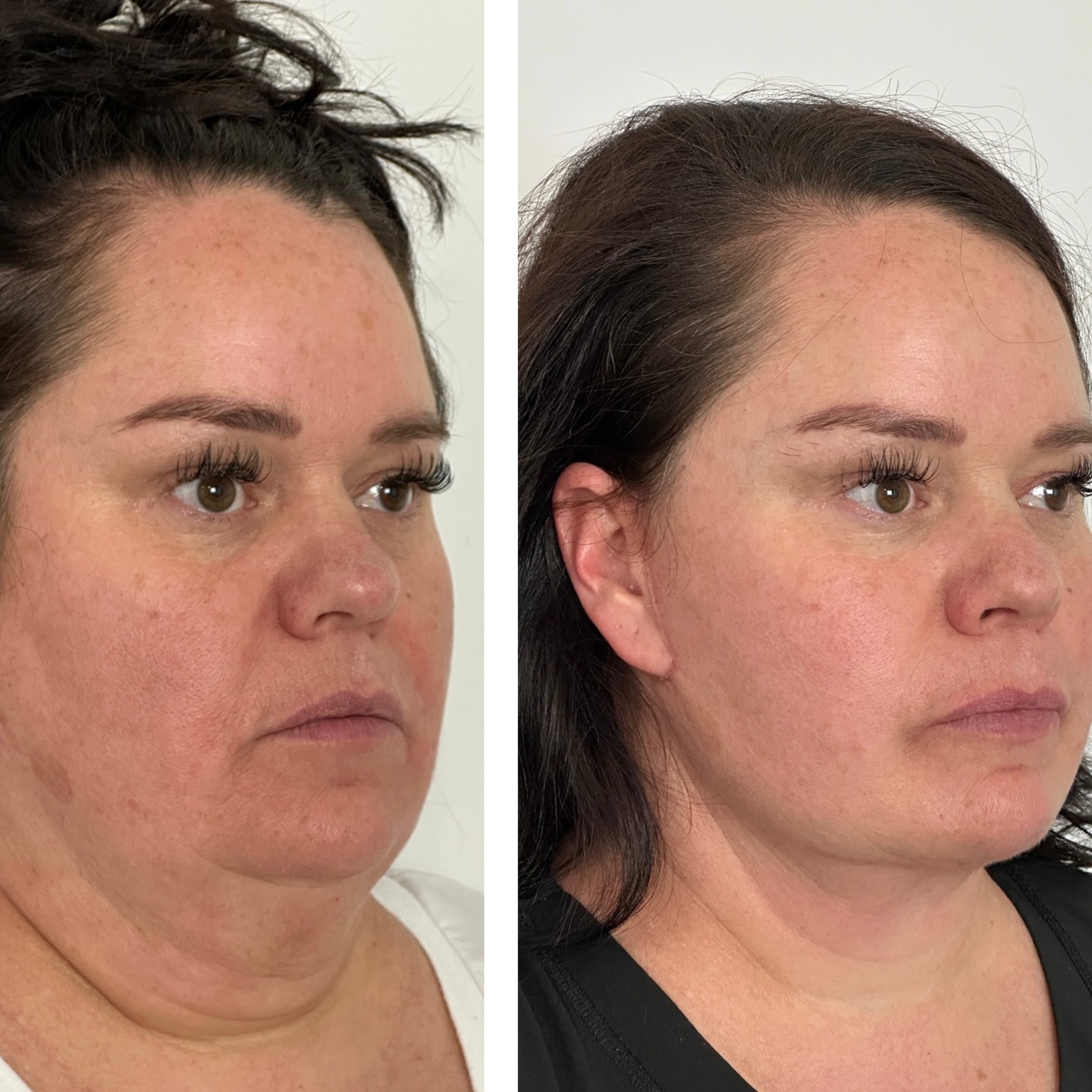 Skin and Face PHX Facebook ad: Esta paciente se muestra aquí tan solo 2…