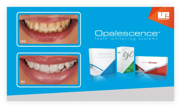 Best of All Facebook ad: OPALESCENCE, whiten your teeth with NO more than…