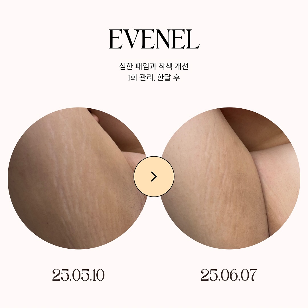 Scar/Stretch marks cover/Skin regeneration Facebook ad: 겨드랑이는 움직임과 마찰이 많은 부위라 튼살이 생기면 특히