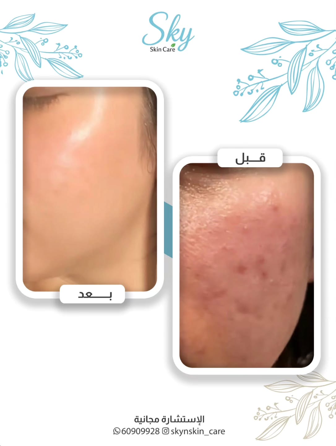 skyskin_care Facebook ad: علاج متطور لإزالة آثار حب الشباب وتحفيز تجديد…