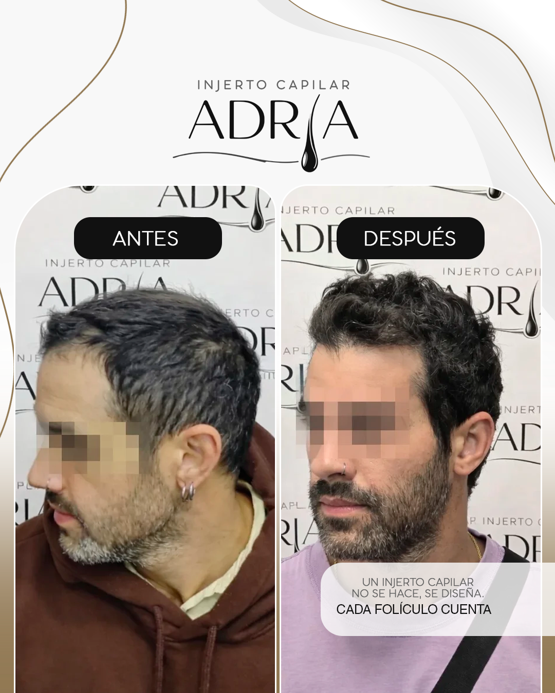 Injerto Capilar Adria Facebook ad