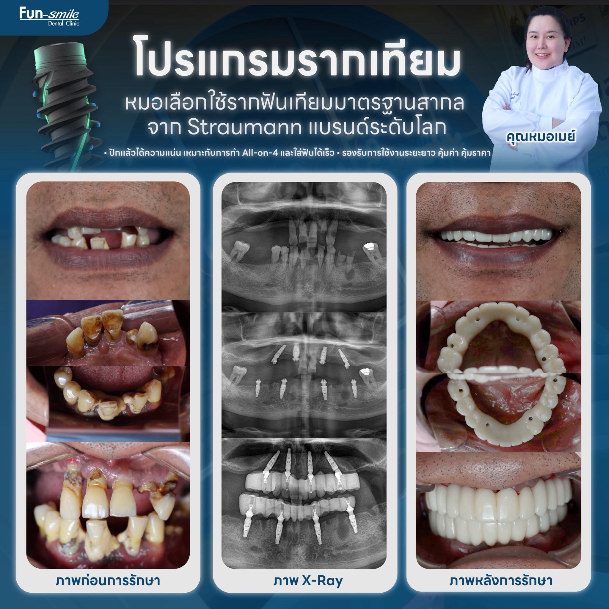 คลินิกฟันสไมล์ จัดฟัน จัดฟันใสโคราช ฟอกสีฟัน รากฟันเทียม วีเนียร์ ฟันปลอม Facebook ad
