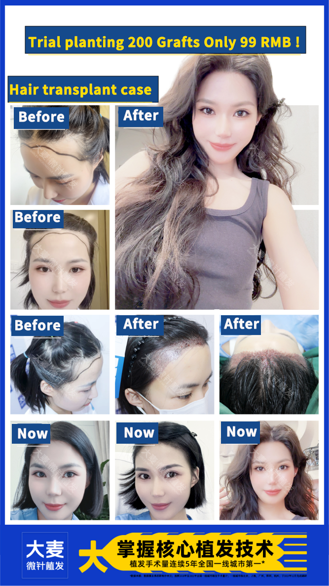 Barley Hair Transplant Facebook ad