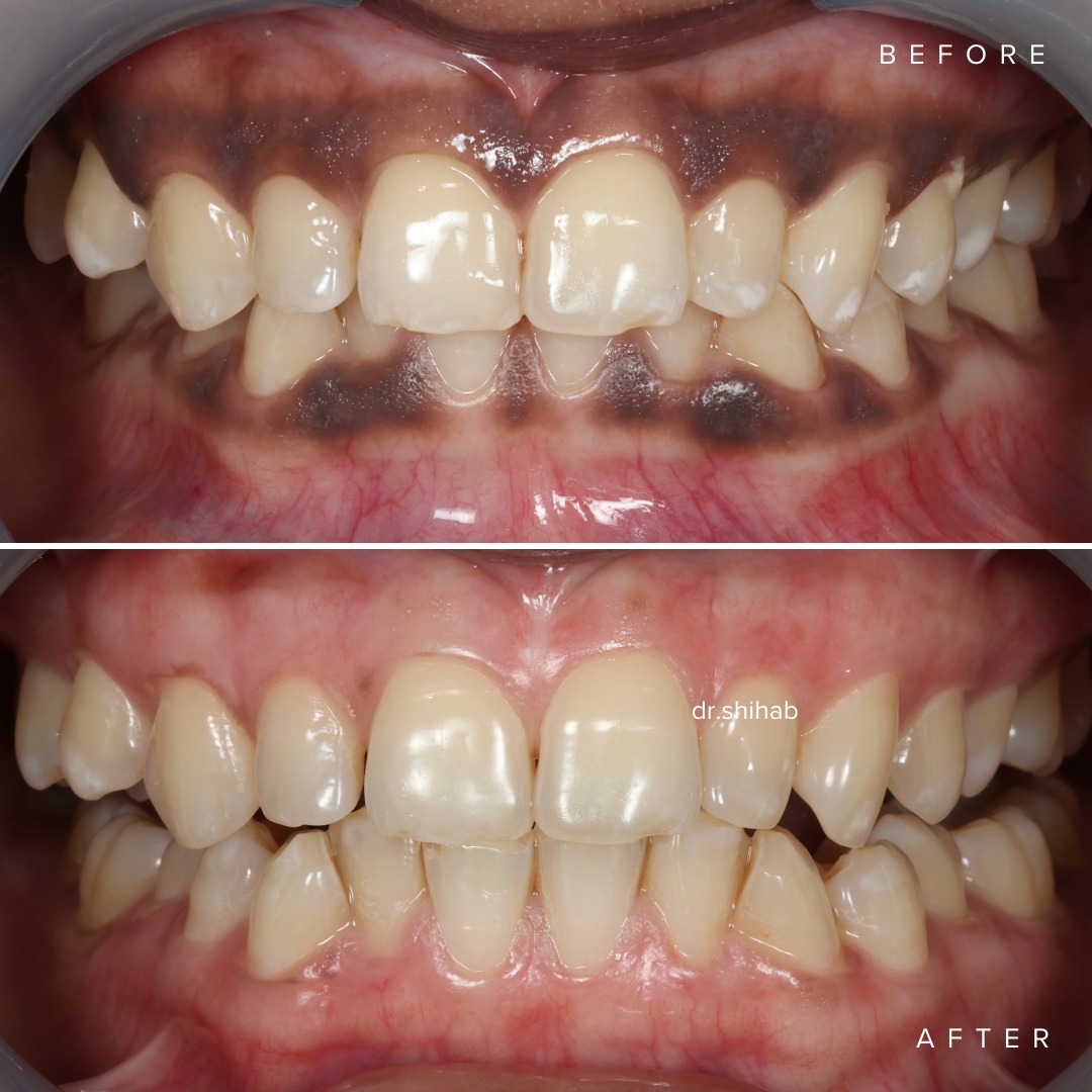 LASER DENTAL Facebook ad