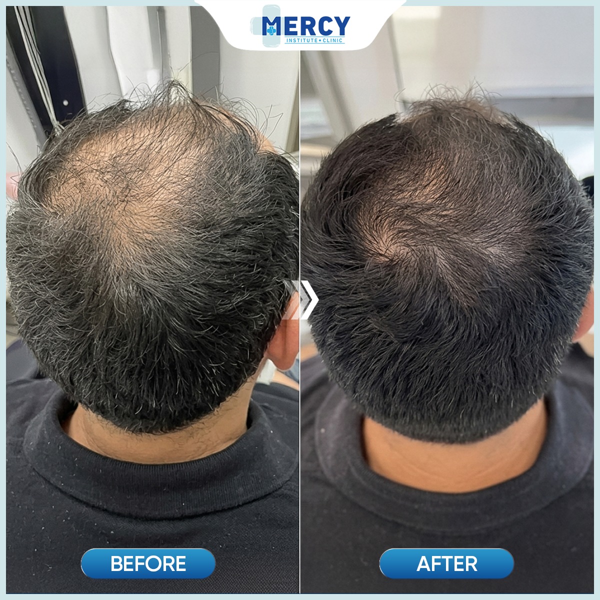 Mercy Hair Beauty Global Facebook ad: Not invasive, no surgery, how did customers 'CURE…