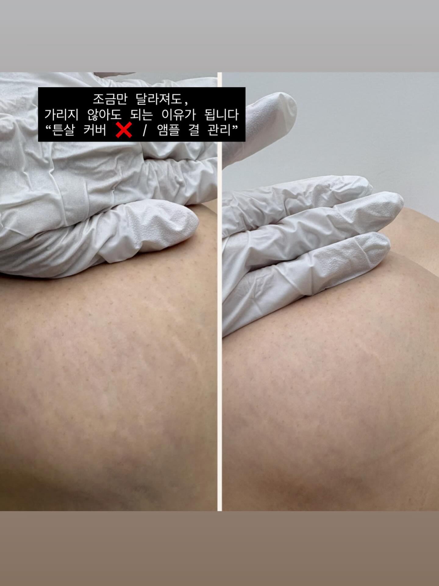 Scar/Stretch marks cover/Skin regeneration Facebook ad: 가릴지, 바꿀지.