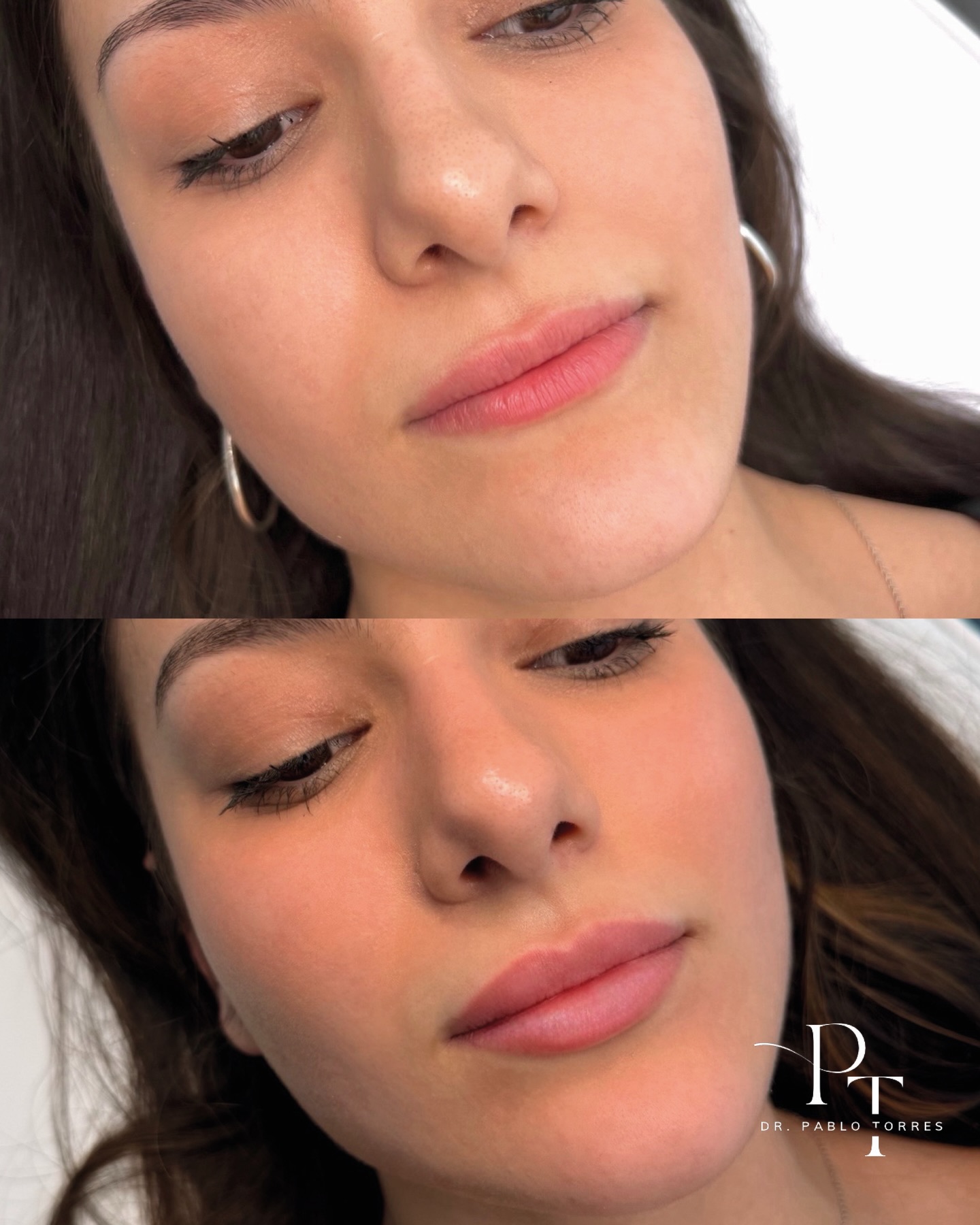 PABLO Torres Estética Facebook ad: Con estos labios no busco que se noten.