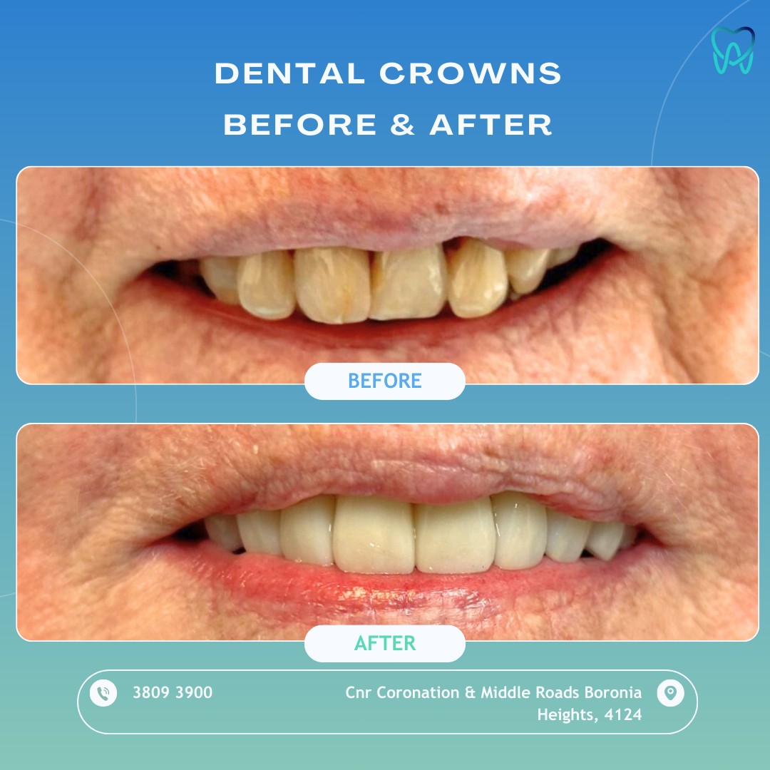 Boronia Heights Family Dental Facebook ad: A truly transformative smile upgrade at Boronia Heights…